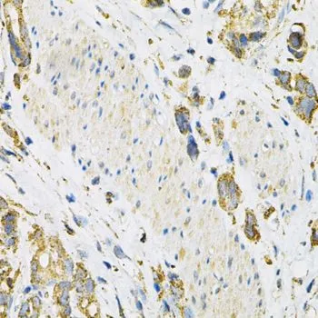 IHC-P analysis of human gastric cancer tissue using GTX32699 LAMP2 antibody. Dilution : 1:100