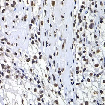 IHC-P analysis of human kidney cancer tissue using GTX32709 Macro H2A.1 antibody. Dilution : 1:100