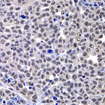 IHC-P analysis of mouse lung cancer tissue using GTX32709 Macro H2A.1 antibody. Dilution : 1:100