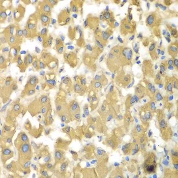 IHC-P analysis of human liver damage tissue using GTX32713 MAP4K3 antibody. Dilution : 1:100