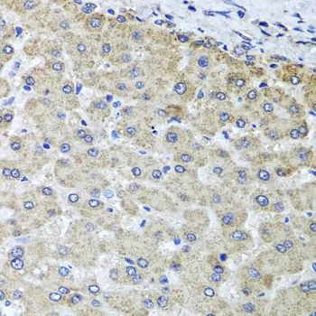 IHC-P analysis of human liver damage tissue using GTX32768 OSGEPL1 antibody. Dilution : 1:100