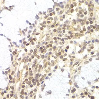IHC-P analysis of human adenomyosis tissue using GTX32784 PHC1 antibody. Dilution : 1:200