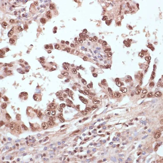 IHC-P analysis of human lung cancer tissue using GTX32832 Rad50 antibody. Dilution : 1:100