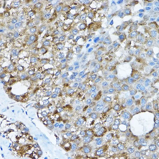 IHC-P analysis of human liver cancer tissue using GTX32847 RPL36 antibody. Dilution : 1:200