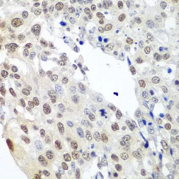 IHC-P analysis of human lung cancer tissue using GTX32862 Securin antibody. Dilution : 1:100