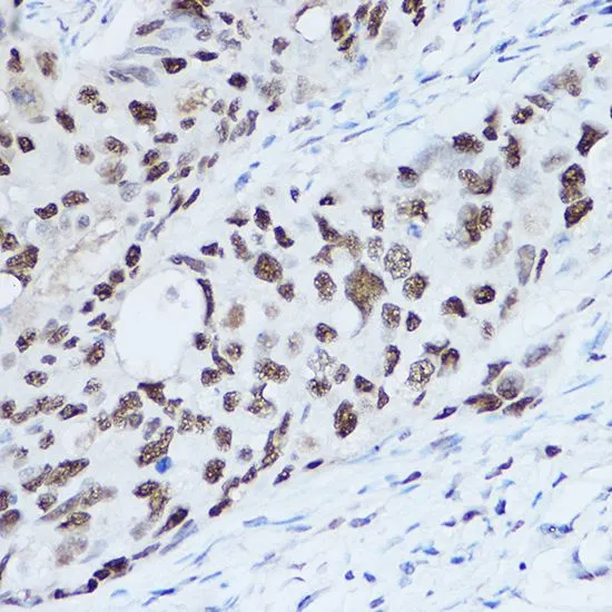 IHC-P analysis of human prostate cancer tissue using GTX32896 SSB antibody. Dilution : 1:100