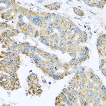 IHC-P analysis of human liver cancer tissue using GTX32906 SYT4 antibody. Dilution : 1:100