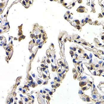 IHC-P analysis of human lung cancer tissue using GTX32963 VEGFD antibody. Dilution : 1:200