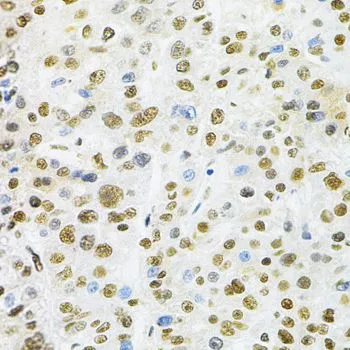 IHC-P analysis of human liver cancer tissue using GTX33031 BAF57 antibody. Dilution : 1:200