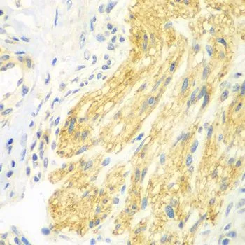 IHC-P analysis of human gastric cancer tissue using GTX33043 Brk antibody. Dilution : 1:100