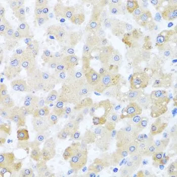 IHC-P analysis of human liver damage tissue using GTX33091 Centrin 1 antibody. Dilution : 1:100