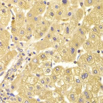 IHC-P analysis of human liver damage tissue using GTX33095 CIKS antibody. Dilution : 1:100