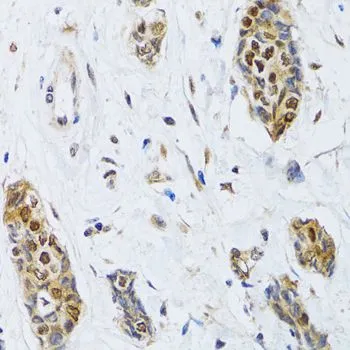 IHC-P analysis of human breast cancer tissue using GTX33096 CIRBP antibody. Dilution : 1:100