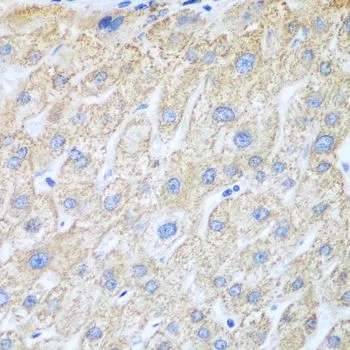 IHC-P analysis of human liver cancer tissue using GTX33113 COX1 antibody. Dilution : 1:100