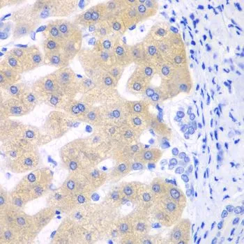 IHC-P analysis of human liver cancer tissue using GTX33135 CYP2C18 antibody. Dilution : 1:100