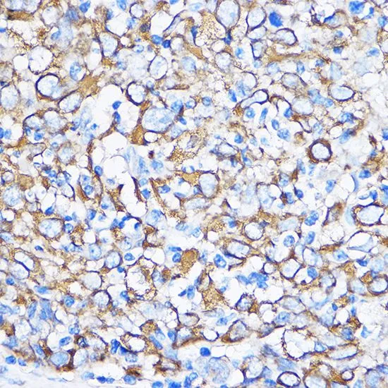 IHC-P analysis of human esophageal cancer tissue using GTX33140 Cytokeratin 5 antibody. Dilution : 1:100