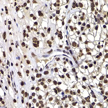 IHC-P analysis of human kidney cancer tissue using GTX33160 DNAJB6 antibody. Dilution : 1:100
