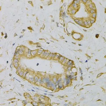 IHC-P analysis of human liver cancer tissue using GTX33175 eIF4B antibody. Dilution : 1:100