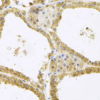 IHC-P analysis of human thyroid cancer tissue using GTX33199 FHL1 antibody. Dilution : 1:100