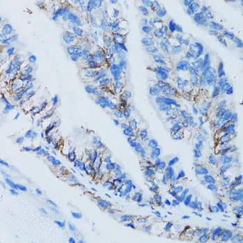 IHC-P analysis of human gastric cancer tissue using GTX33214 Galectin 8 antibody. Dilution : 1:100