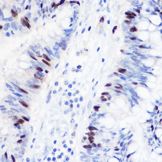 IHC-P analysis of human colon carcinoma tissue using GTX33218 Geminin antibody. Dilution : 1:100