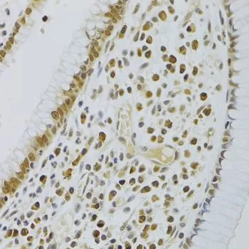 IHC-P analysis of human colon cancer tissue using GTX33240 HEXIM1 antibody. Dilution : 1:100