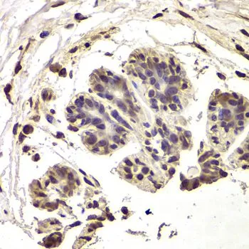 IHC-P analysis of human breast cancer tissue using GTX33271 INTS6 antibody. Dilution : 1:100