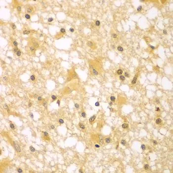 IHC-P analysis of human brain cancer tissue using GTX33383 PAK6 antibody. Dilution : 1:100