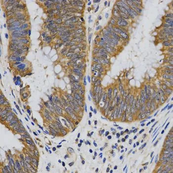 IHC-P analysis of human rectal cancer tissue using GTX33409 PIBF1 antibody. Dilution : 1:200