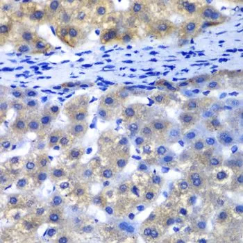 IHC-P analysis of human liver damage tissue using GTX33440 PSMD8 antibody. Dilution : 1:100