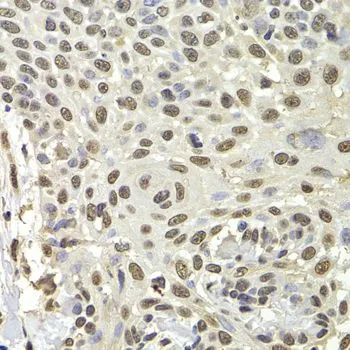 IHC-P analysis of human well-differentiated squamous skin carcinoma tissue using GTX33446 PUF60 antibody. Dilution : 1:100