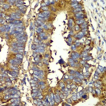 IHC-P analysis of human colon carcinoma tissue using GTX33449 QARS antibody. Dilution : 1:100