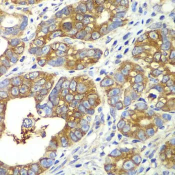 IHC-P analysis of human gastric cancer tissue using GTX33449 QARS antibody. Dilution : 1:100