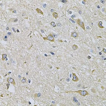 IHC-P analysis of human brain cancer tissue using GTX33451 RAB17 antibody. Dilution : 1:100