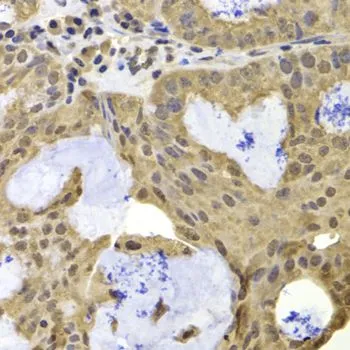 IHC-P analysis of human oophoroma tissue using GTX33458 RAP1 antibody. Dilution : 1:100
