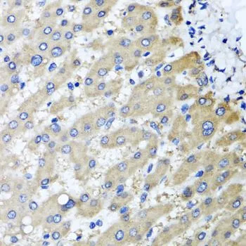 IHC-P analysis of human liver damage tissue using GTX33462 RBP2 antibody. Dilution : 1:100