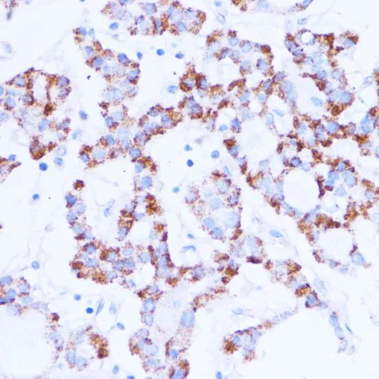 IHC-P analysis of human thyroid cancer tissue using GTX33499 SIRT3 antibody. Dilution : 1:100