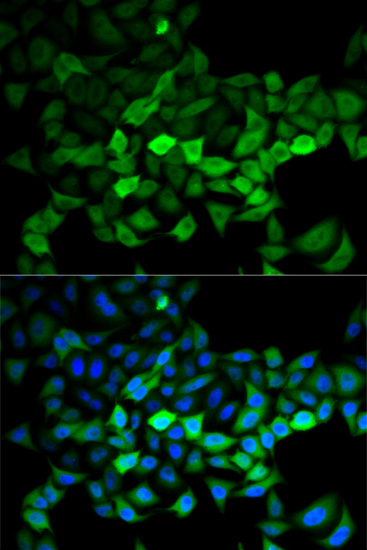 IHC-P analysis of human gastric cancer tissue using GTX33567 UBE2C antibody. Dilution : 1:100