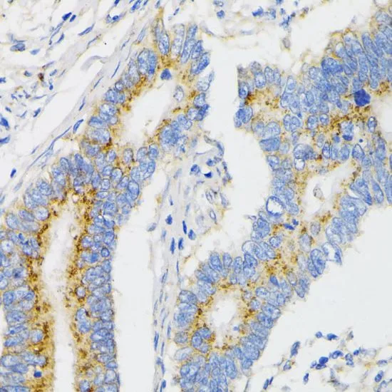 IHC-P analysis of human colon carcinoma tissue using GTX33578 VDP / p115 antibody. Dilution : 1:100