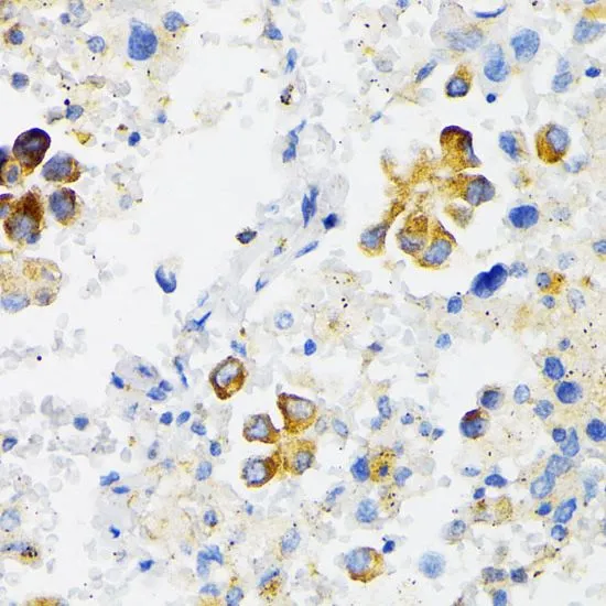 IHC-P analysis of human lung cancer tissue using GTX33578 VDP / p115 antibody. Dilution : 1:100