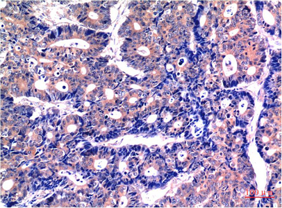 IHC-P analysis of human stomach carcinoma tissue using GTX33981 GSK3 beta antibody [2C6]. Dilution : 1:200