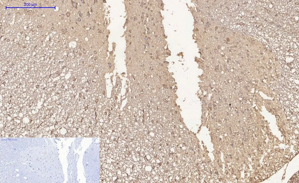 Immunohistochemistry (IHC) analysis of paraffin-embedded Human Colon Carcinoma Tissue using HADC1 Mouse Monoclonal Antibody diluted at 1:200.