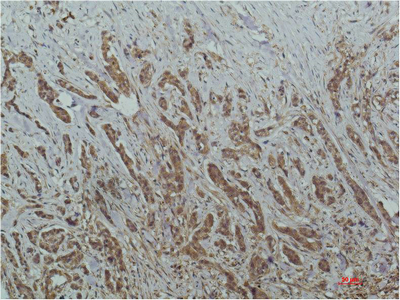 IHC-P analysis of human breast carcinoma tissue using GTX33988 HDAC1 antibody [4E1]. Dilution : 1:200