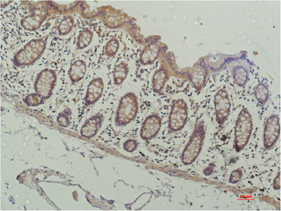 IHC-P analysis of human colon carcinoma tissue using GTX33988 HDAC1 antibody [4E1]. Dilution : 1:200