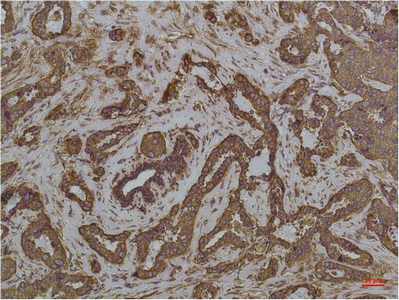 IHC-P analysis of human colon carcicnoma tissue using GTX33998 Grp78 antibody [8G3]. Dilution : 1:200