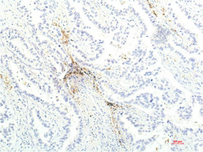 IHC-P analysis of human lung carcinoma tissue using GTX34019 JAK1 antibody [7G6]. Dilution : 1:200