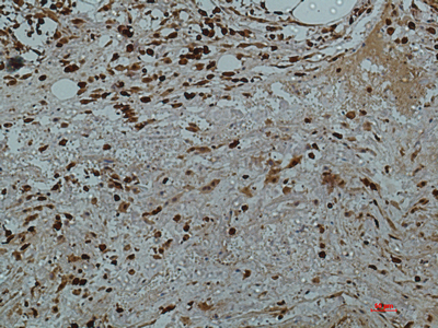 IHC-P analysis of human colon tissue using GTX34031 Galectin 3 antibody [8D7]. Dilution : 1:50
