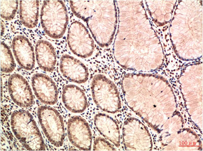 IHC-P analysis of human colon carcinoma tissue using GTX34047 ATM antibody [4G9]. Dilution : 1:200
