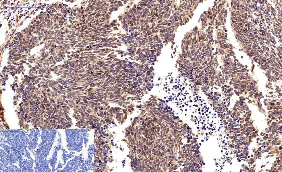 IHC-P analysis of human lung cancer tissue using GTX34059 Survivin antibody [Mix]. Negative control (the lower left coner) was secondary antibody only. Antigen retrieval : Sodium citrate pH6.0 was used for antibody retrieval (>98oC, 20min) Dilution : 1:200