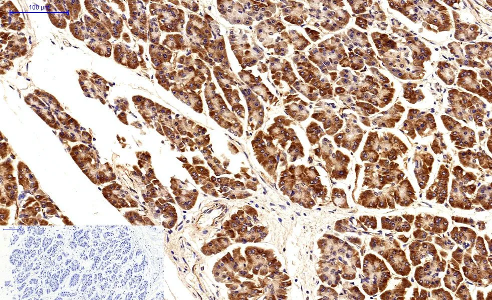 IHC-P analysis of human stomach cancer tissue using GTX34059 Survivin antibody [Mix]. Negative control (the lower left coner) was secondary antibody only. Antigen retrieval : Sodium citrate pH6.0 was used for antibody retrieval (>98oC, 20min) Dilution : 1:200